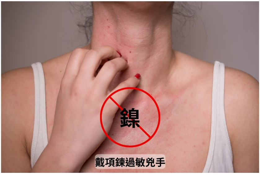 「鎳」就是造成我們皮膚過敏的元凶