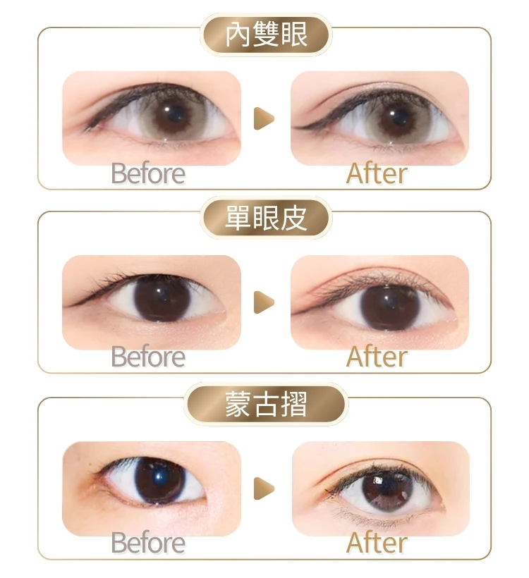 Before After 內雙眼 單眼皮 蒙古摺