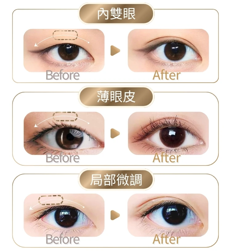 Before After 內雙眼 單眼皮 蒙古摺