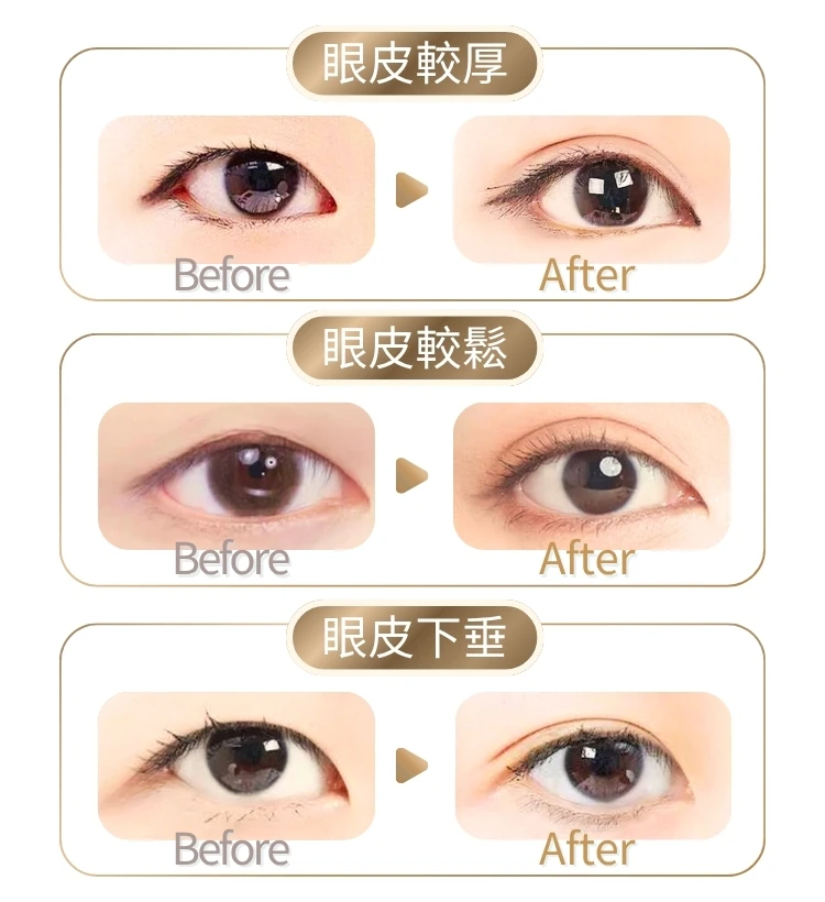 Before After 眼皮較厚 眼皮較鬆 眼皮下垂