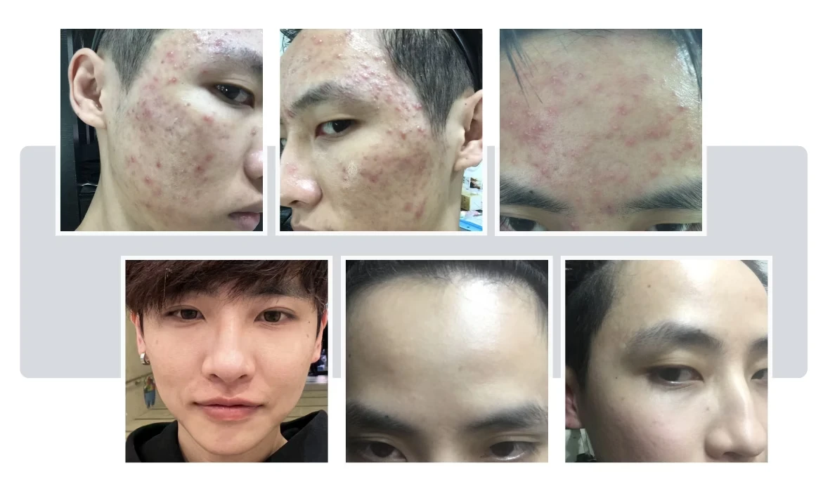 長在下巴、額頭的內包粉刺,成因有不同嗎?