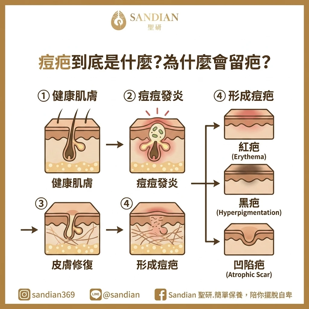 痘疤到底是什麼？為什麼會留疤？