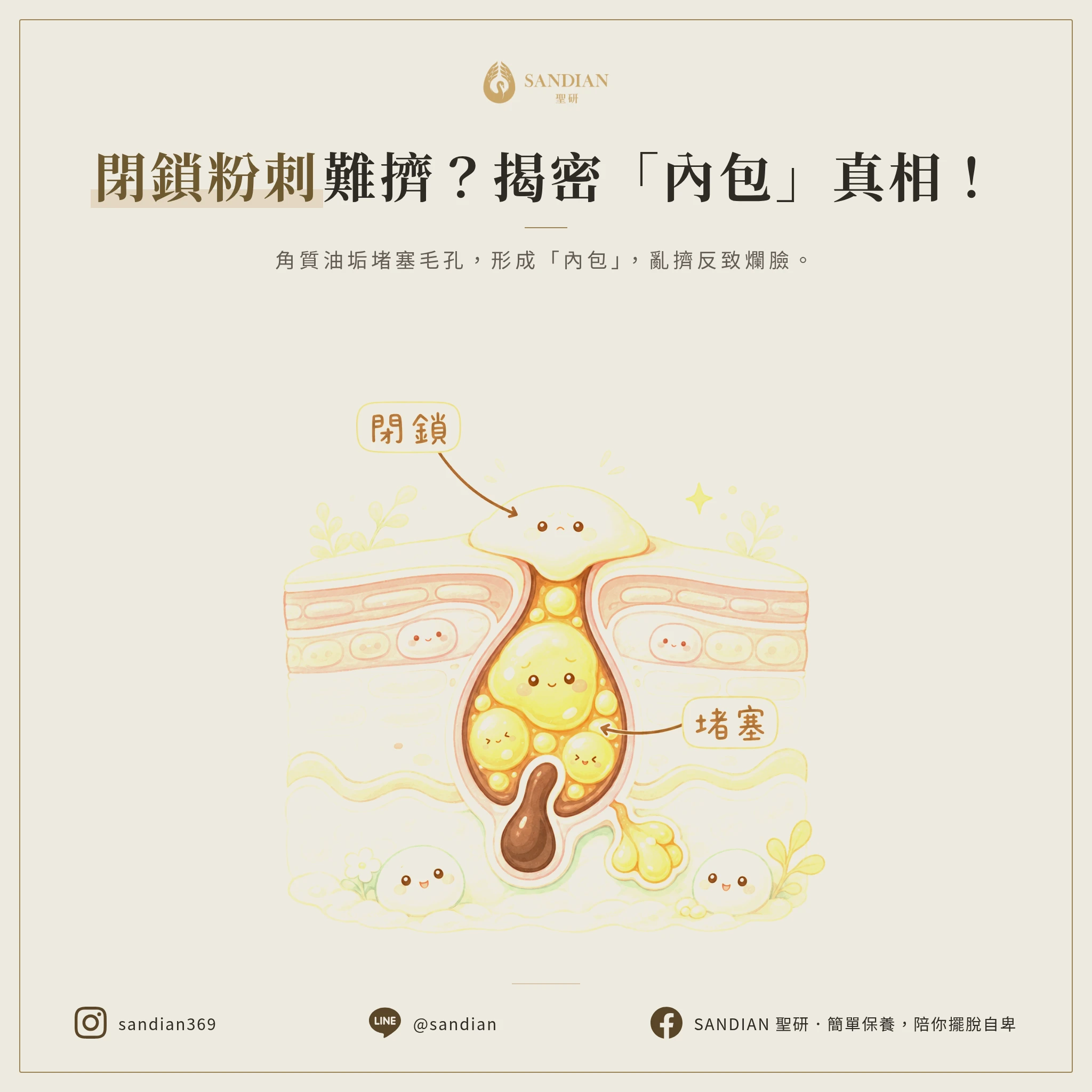 閉鎖性粉刺到底是什麼?為什麼老是擠不出來?