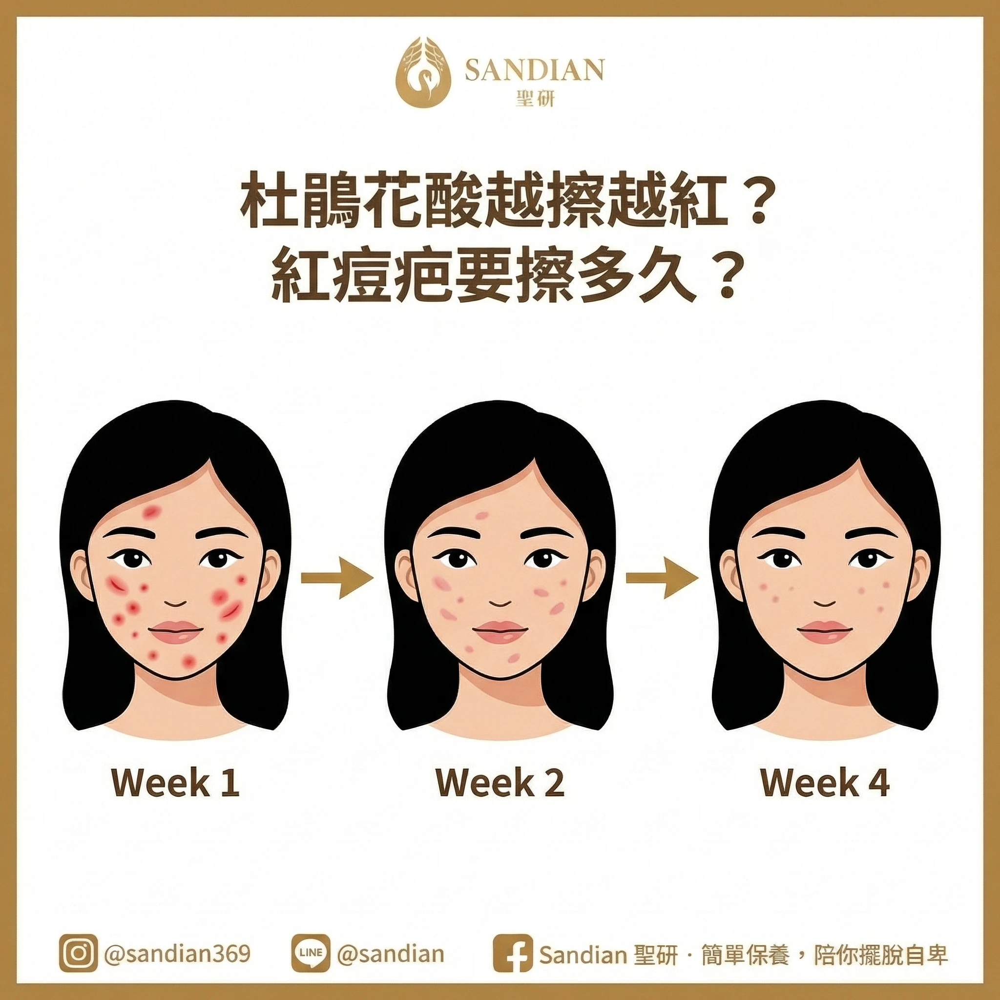 杜鵑花酸功效與藥膏怎麼選:爆痘期與紅痘疤時間表
