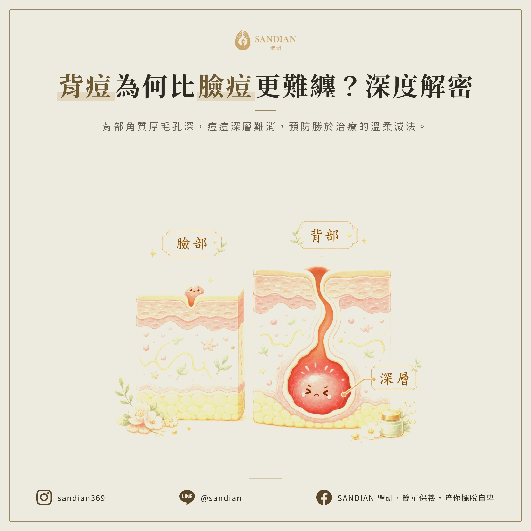 為什麼背痘比臉上的痘痘更難搞?