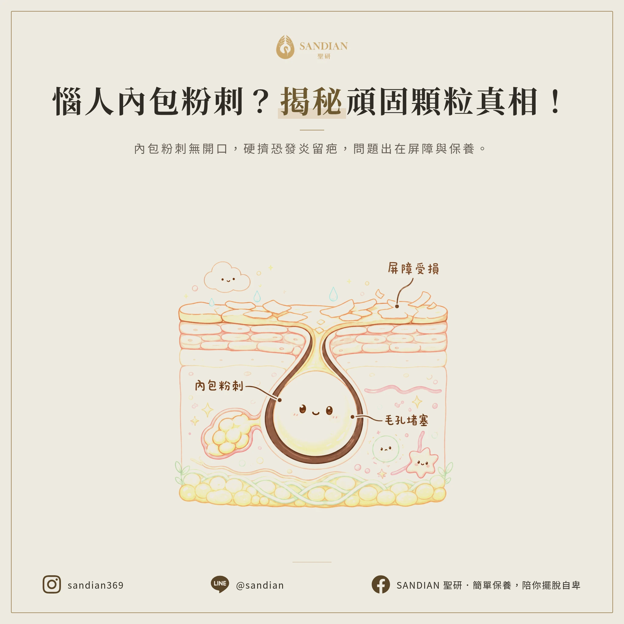 一、什麼是內包粉刺?為什麼一直清不掉