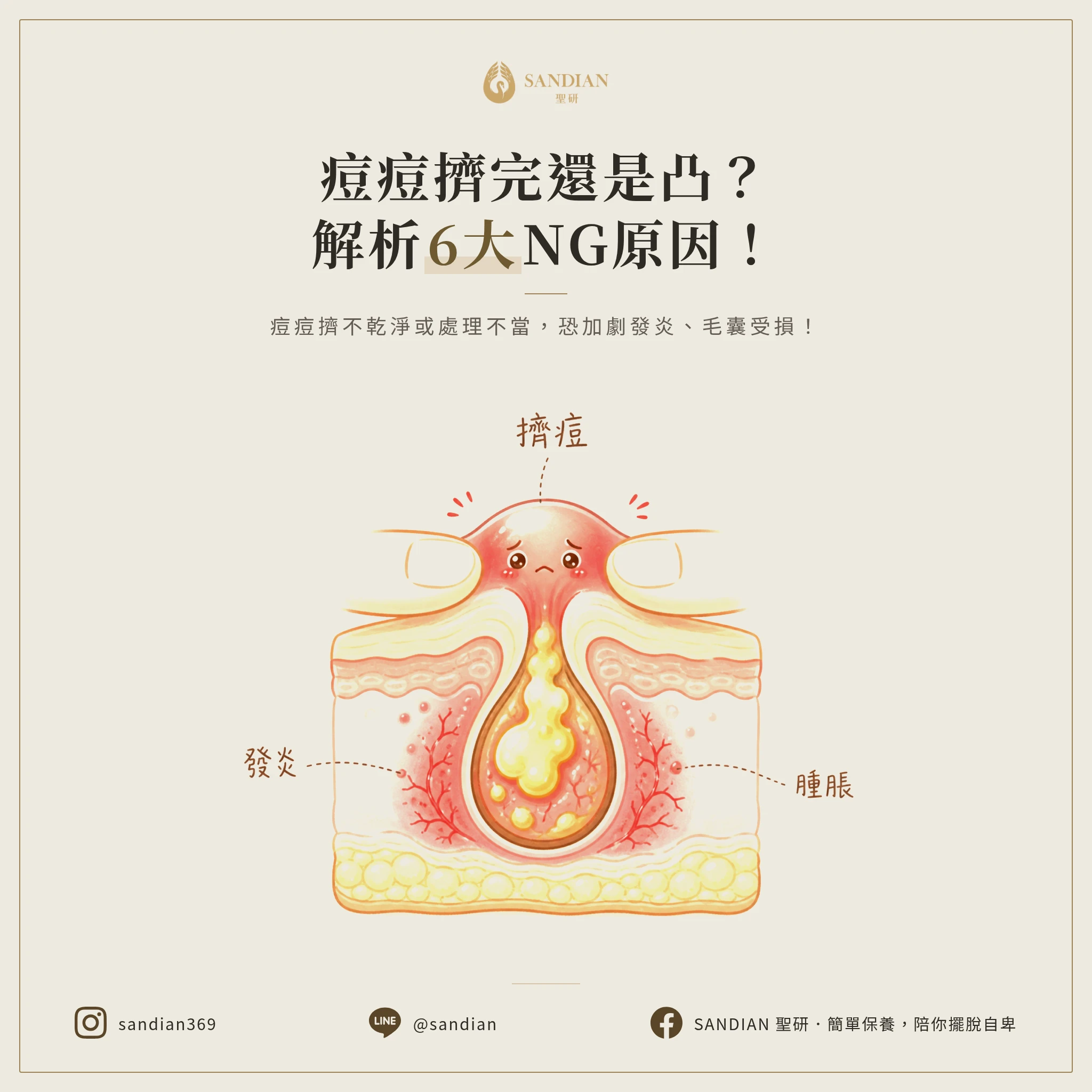 痘痘擠完還是凸凸的,是哪裡出錯了?
