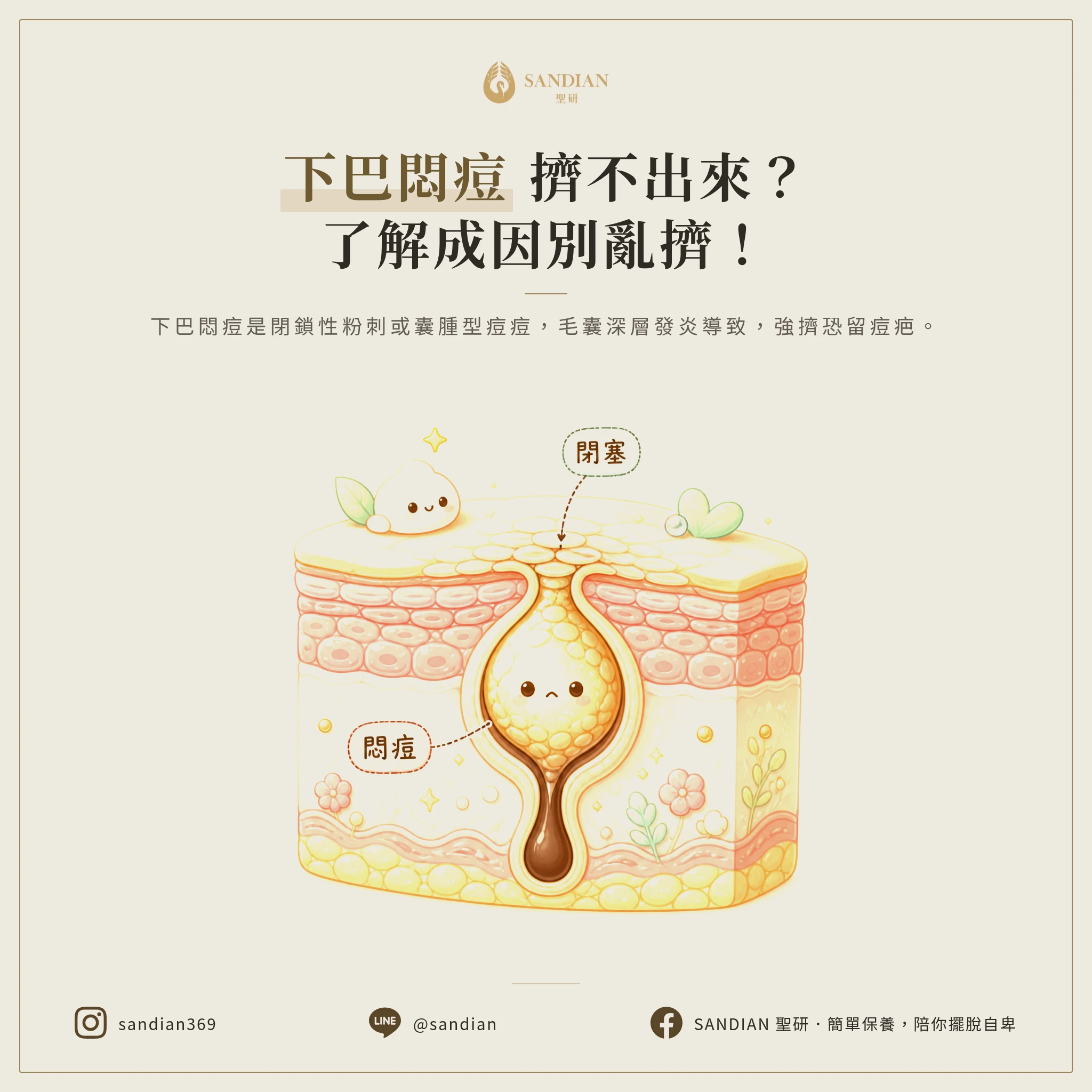 內包痘怎麼消?八年抗痘經驗推薦的 5 個有效處理步驟