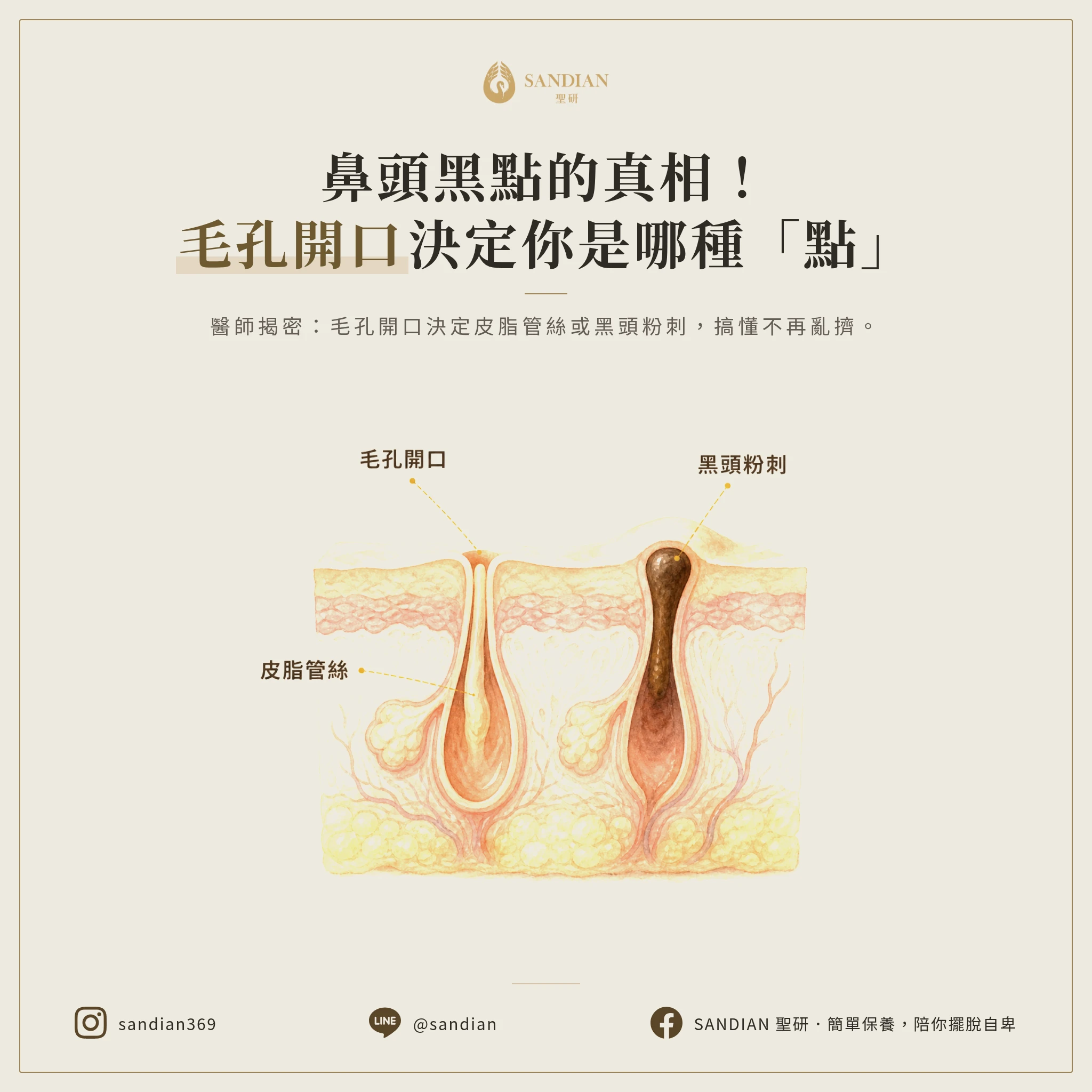 鼻子上的黑點到底是什麼?毛孔開口狀態決定一切