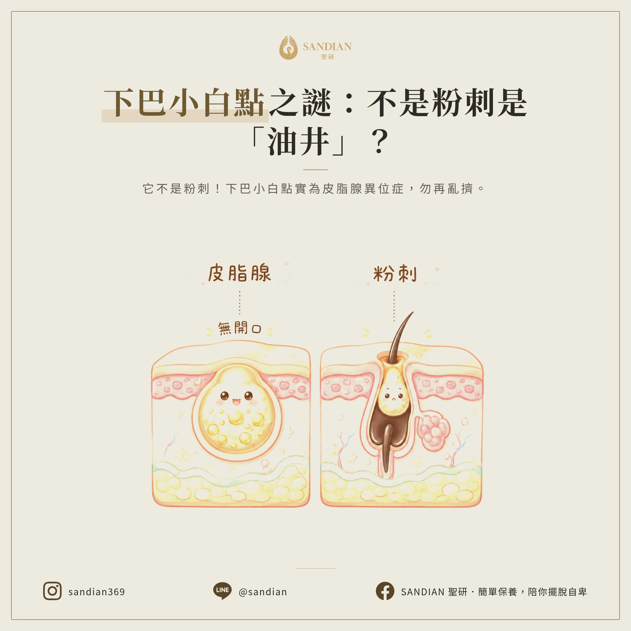 一、下巴小白點到底是什麼?為什麼不是粉刺?