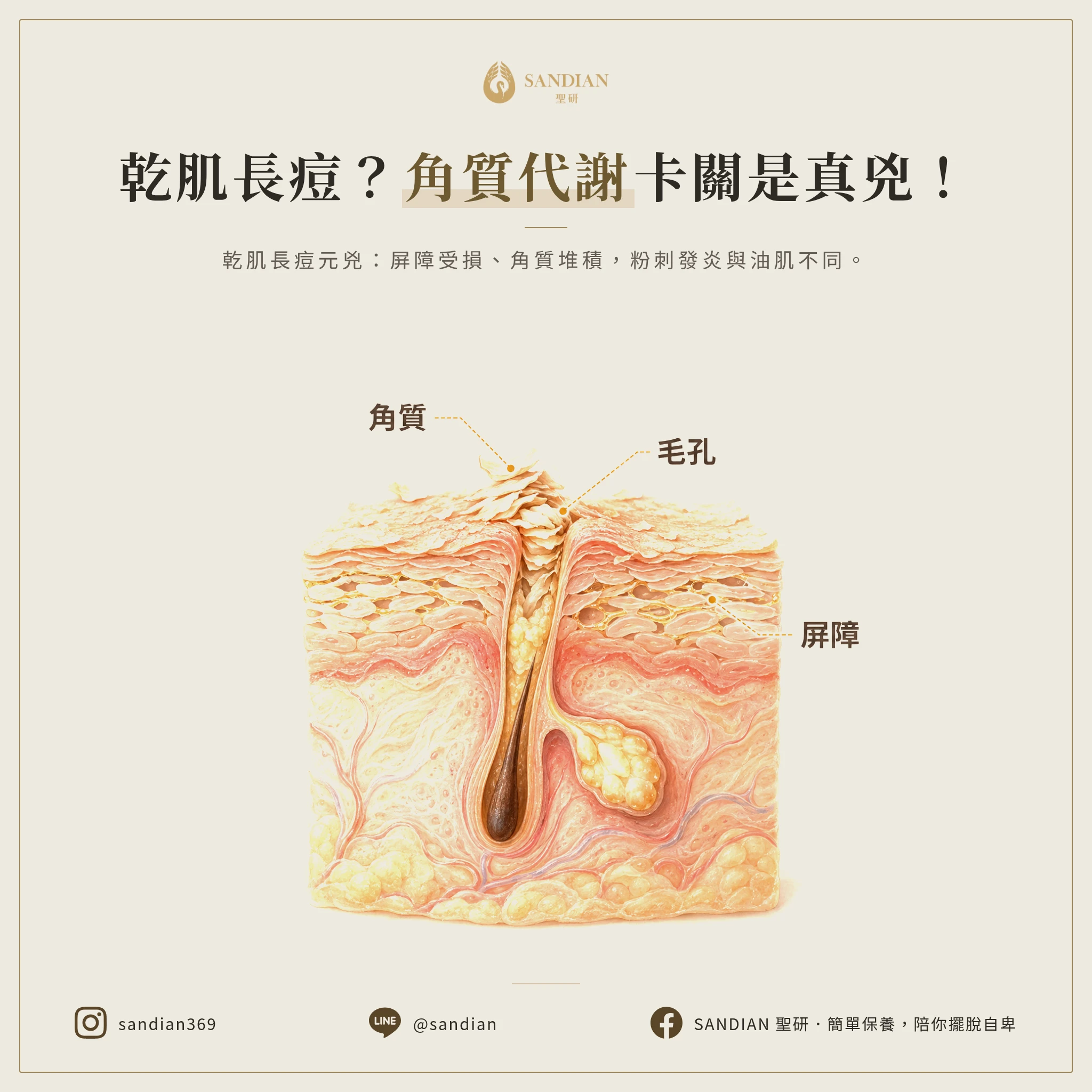 為什麼乾性肌會長痘?角質代謝卡住才是真兇