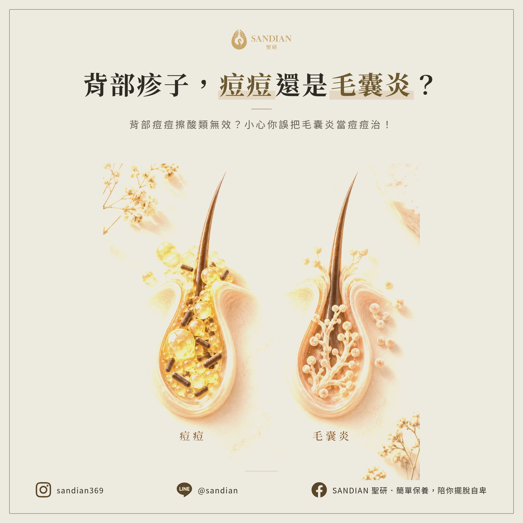 一、你確定這是背部痘痘?還是背部毛囊炎?