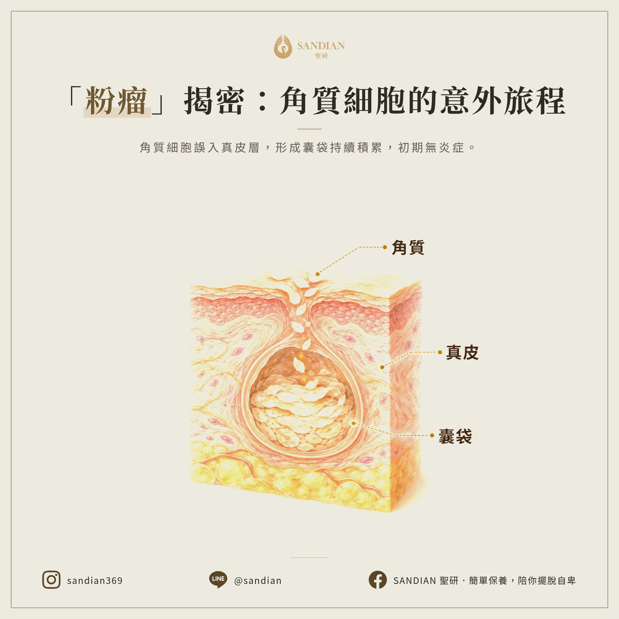 一、粉瘤的成因與形成機制