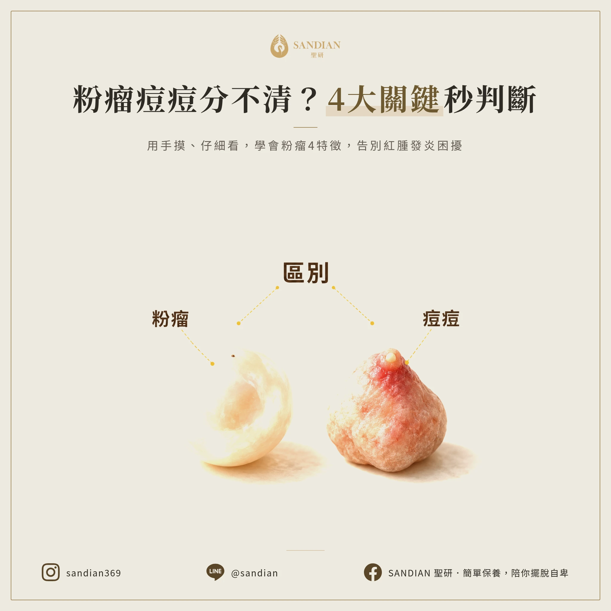 二、粉瘤 VS 痘痘|4 個判斷重點