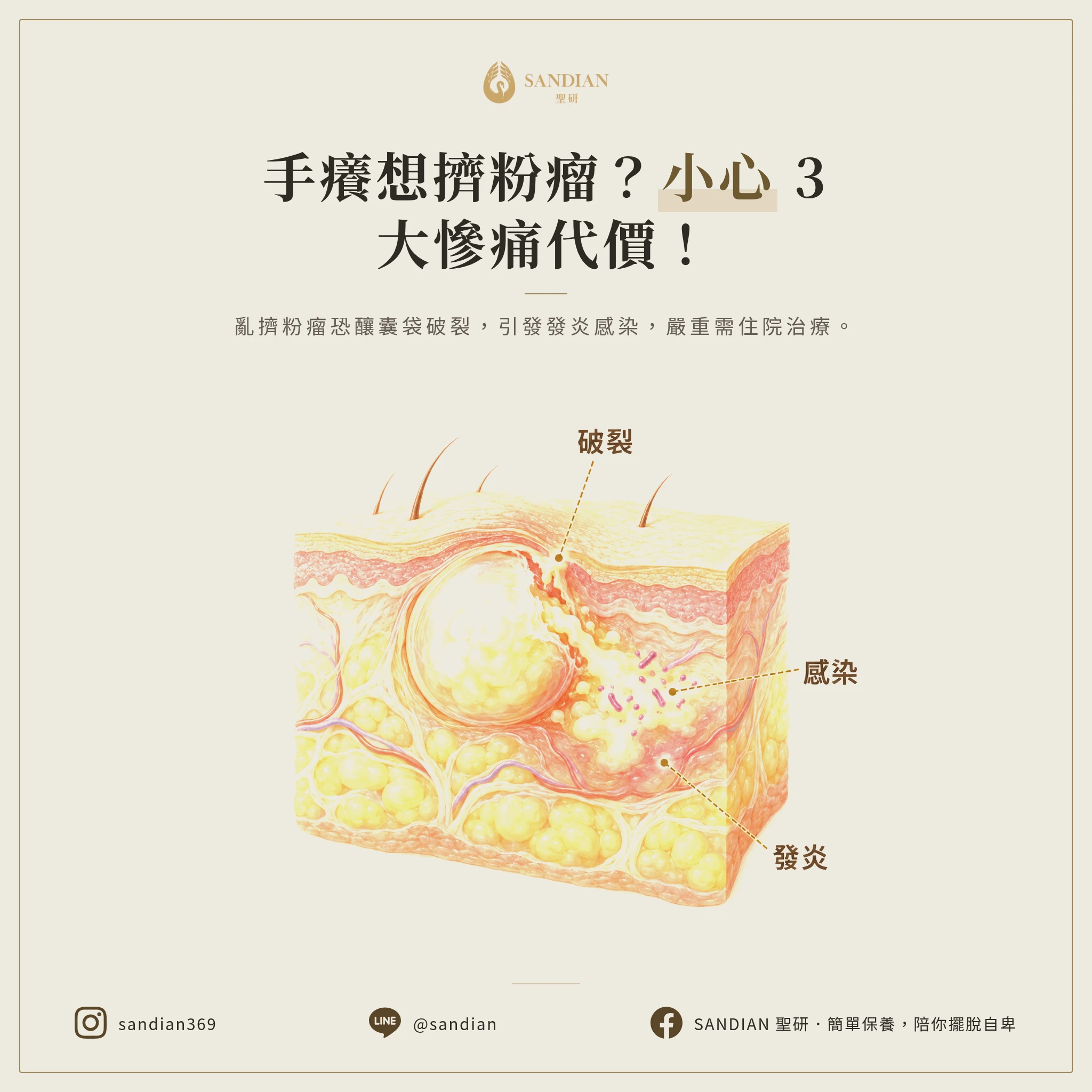 三、擠壓粉瘤的 3 大風險