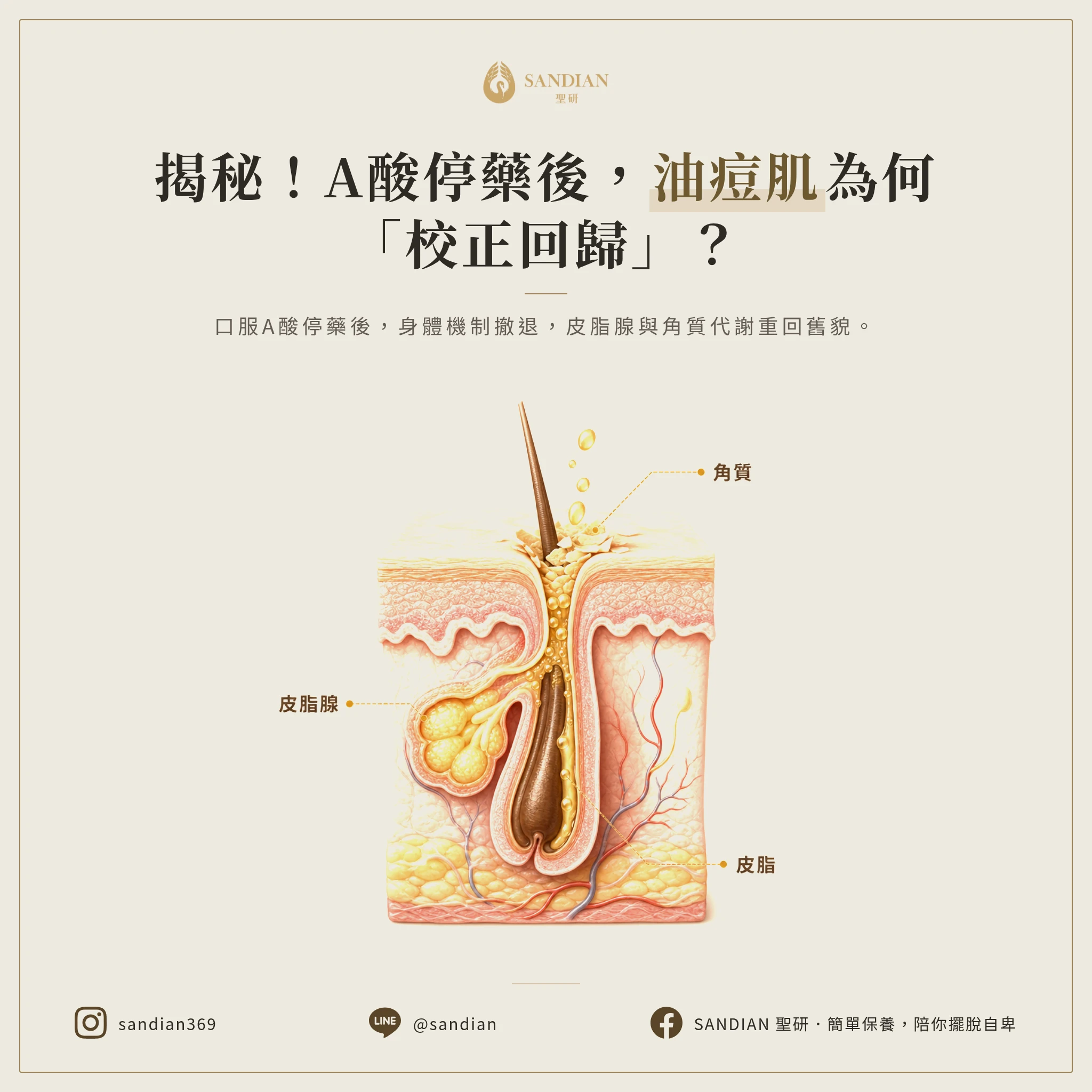 一、復發真相：為什麼停藥後油光與粉刺會「校正回歸」？