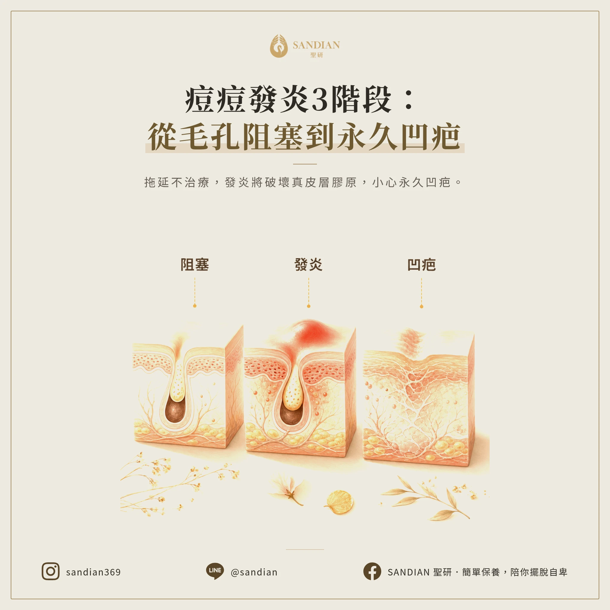 一、痘痘發炎的 3 個不可逆階段