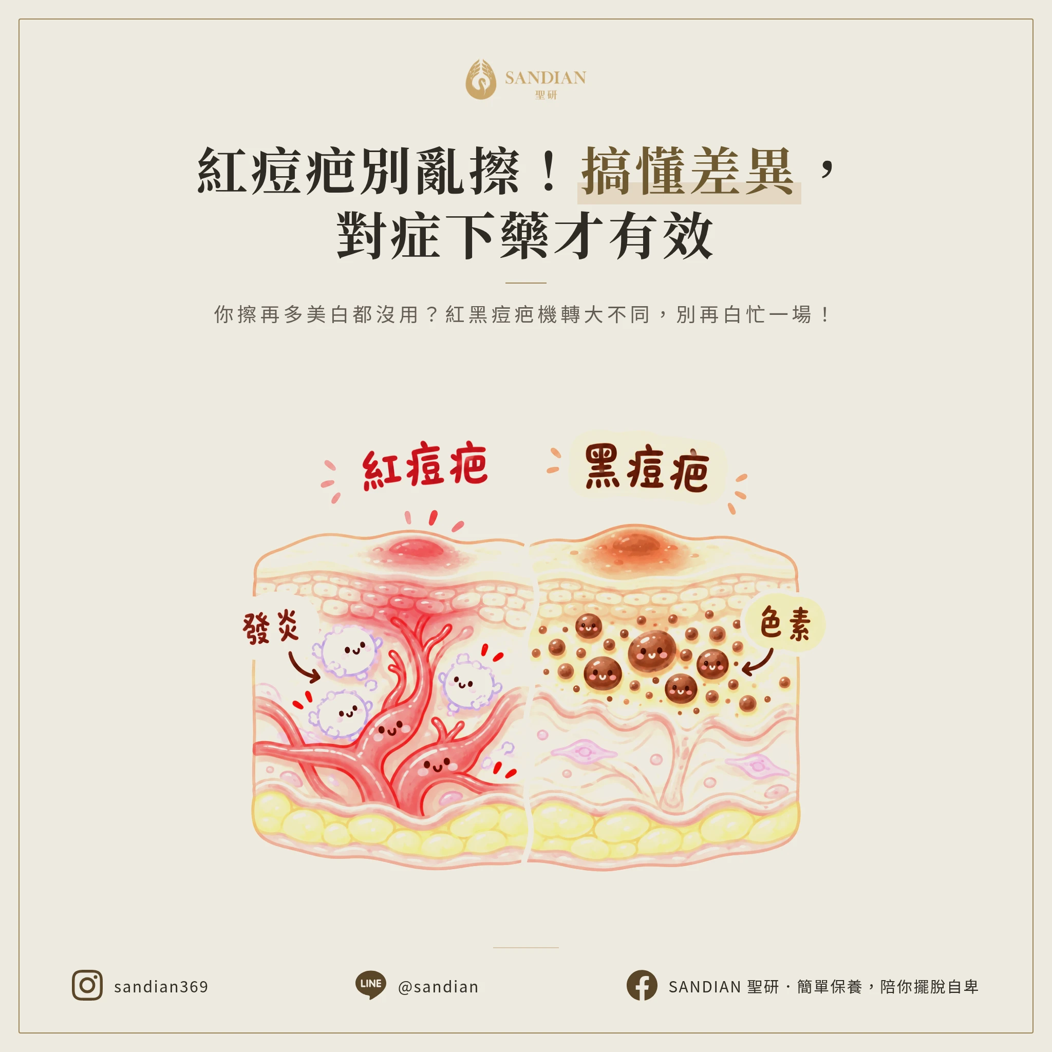 一、2 種痘疤的本質差異:為什麼紅痘疤擦美白根本沒用