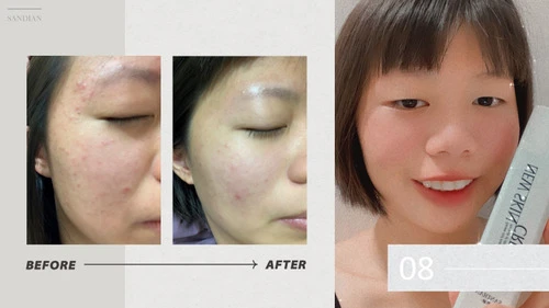 女生常見的敏感泛紅怎麼改善？案例示範從過度清潔到穩定膚況的關鍵
