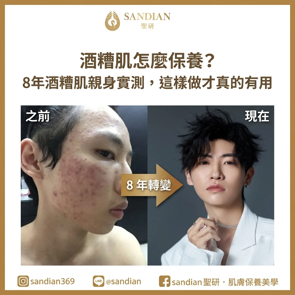 酒糟肌怎麼保養？8年酒糟肌親身實測，這樣做才真的有用 | Sandian 聖研 Alan