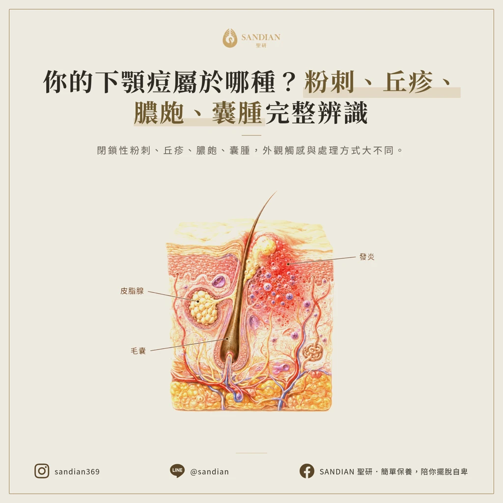 從粉刺到囊腫:辨識你的下顎線痘屬於哪一種