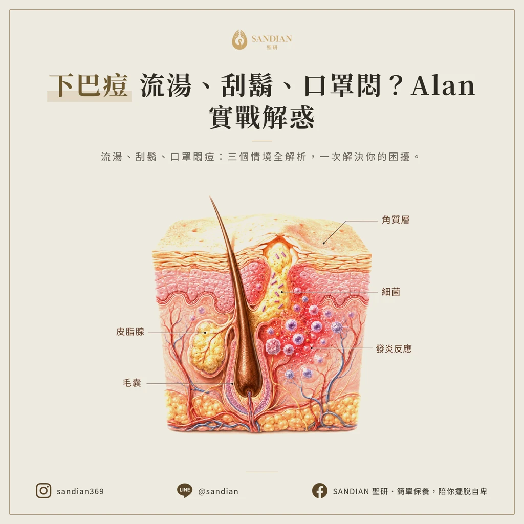 下巴痘痘常見問題 Q&A：破皮、刮鬍、口罩三種情境