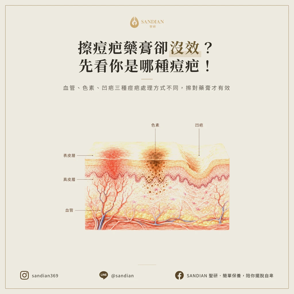 痘疤藥膏擦了為什麼沒用?先搞懂你擦的是哪一種痘疤