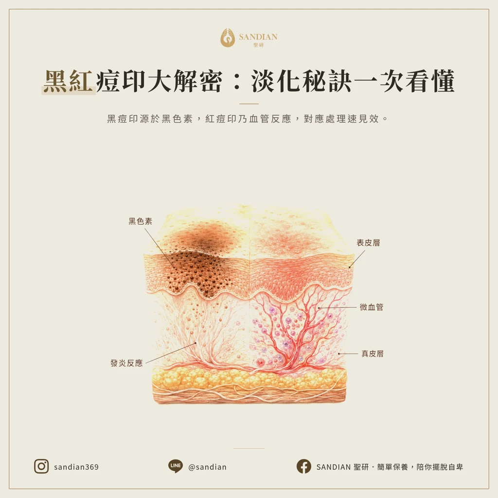 黑痘印跟紅痘印差在哪?怎麼讓它淡掉