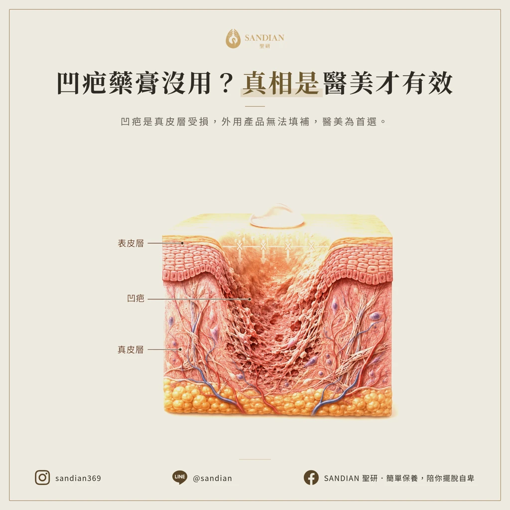 凹疤擦痘疤藥膏或保養品真的有用嗎