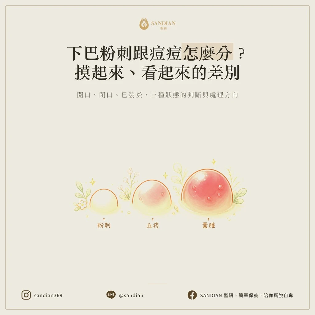 下巴粉刺跟痘痘怎麼分?摸起來、看起來的差別