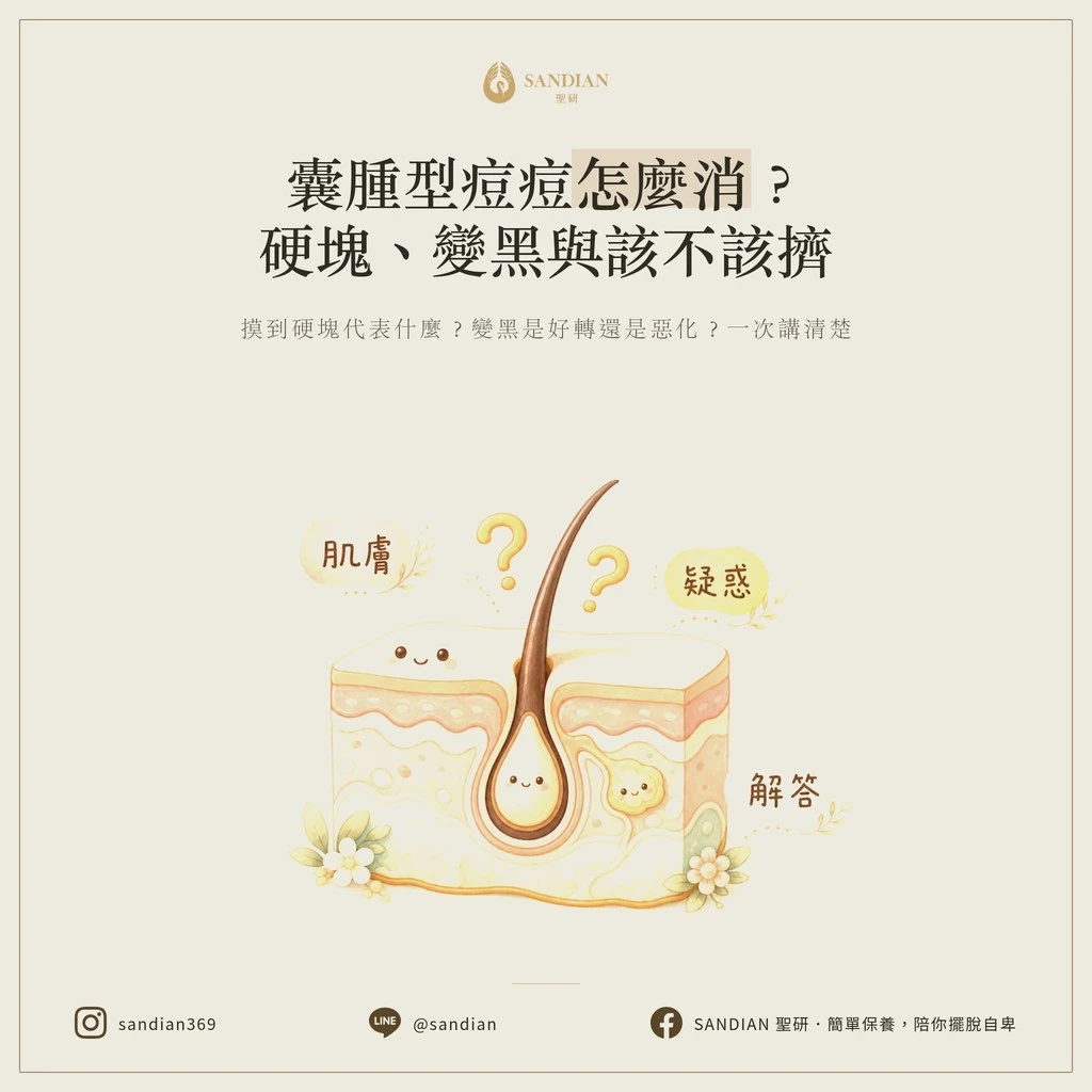 囊腫型痘痘怎麼消？硬塊、變黑與該不該擠
