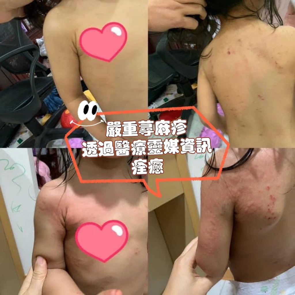 文章分享~女兒蕁麻疹療癒
