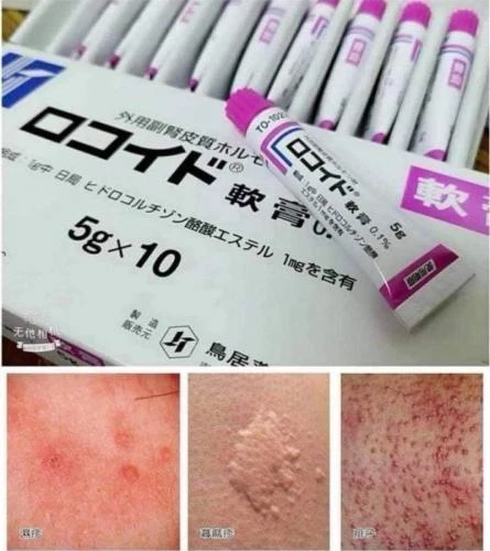 現貨 日本鳥居製藥－白癜風濕疹皮炎藥膏 5g/條