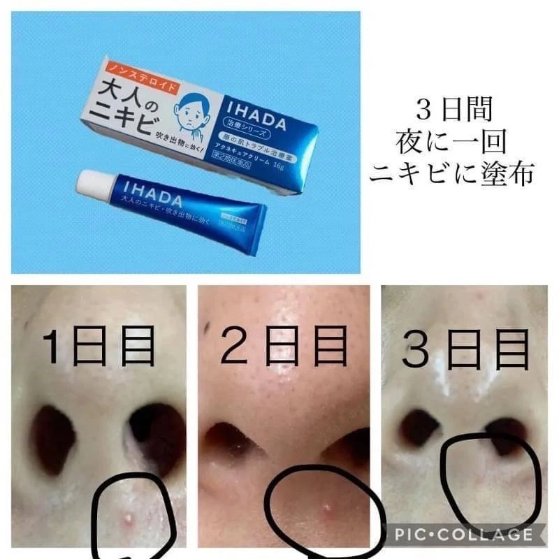 現貨 日本資生堂 IHADA 成人痘痘治療軟膏26g